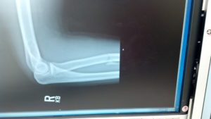 Broken bone