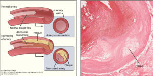 atherosclerotic_plaque