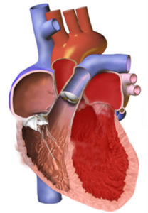 dilated_cardiomyopathy