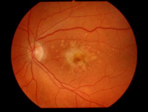 Macular_degeneration