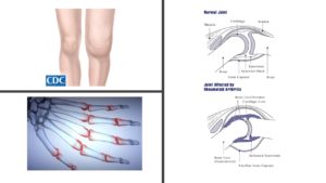 rheumatoid_arthritis