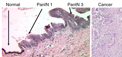 Pancreas_neoplasia_carcinoma_sequence