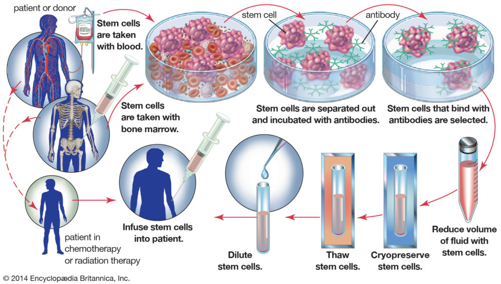 Blood_Stem_Cell_Transplant